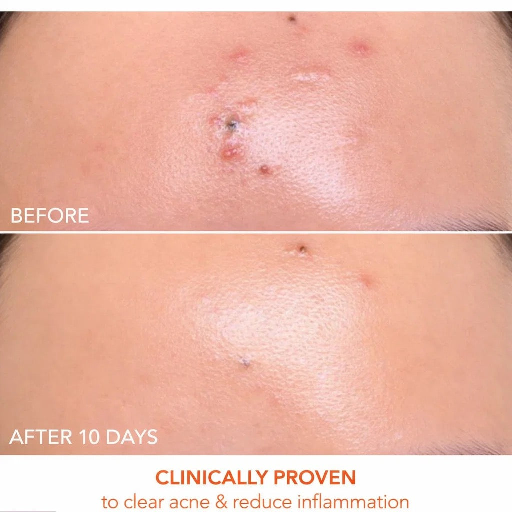 RadianceRX Red Light Mask